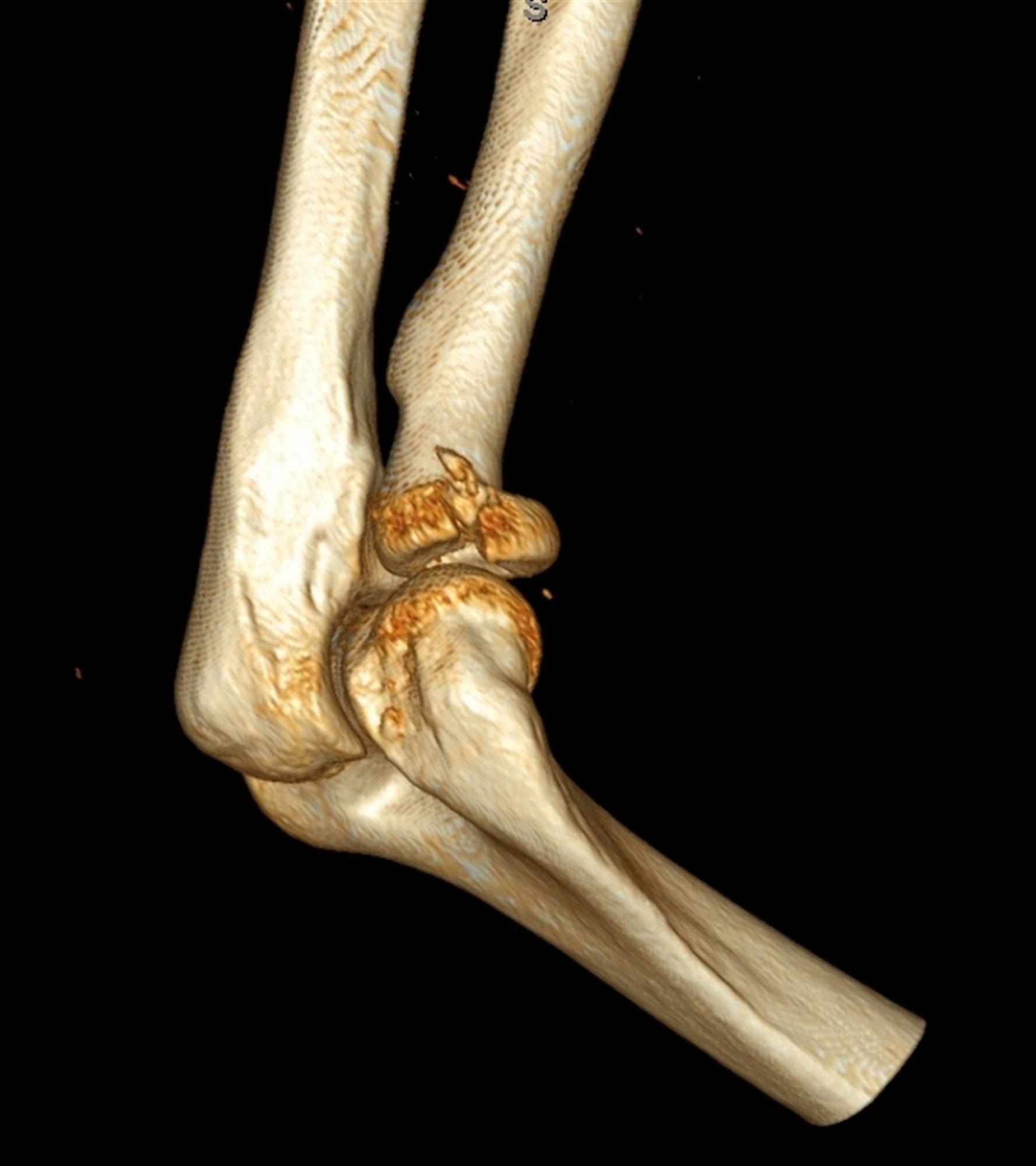 Radial Head Fractures Trauma Orthobullets